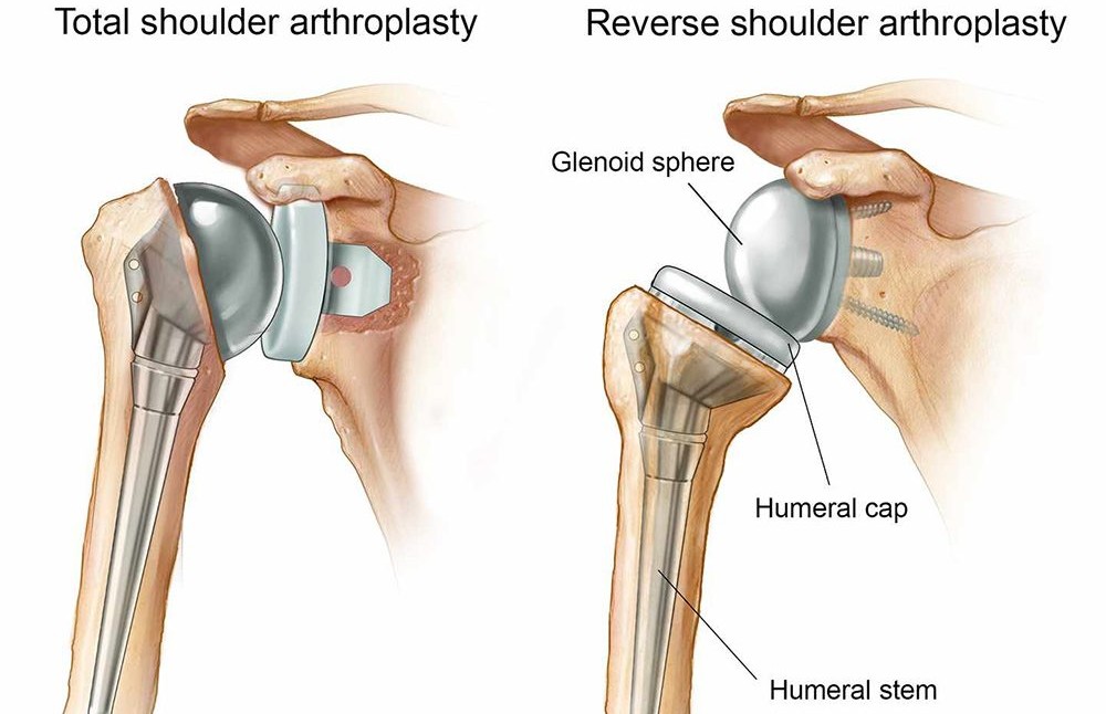 Shoulder