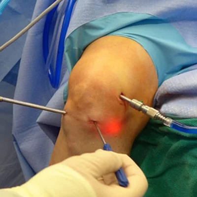 Arthroscopy