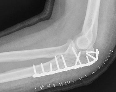 Fracture Fixation