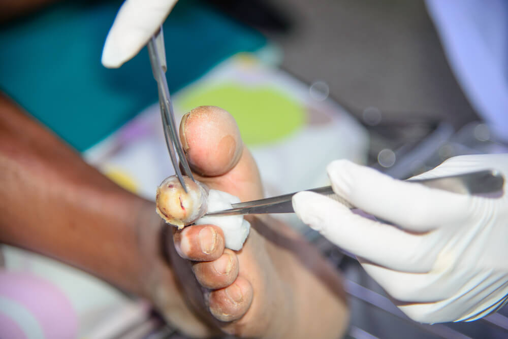 Wound Debridement