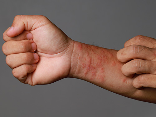 Atopic Dermatitis