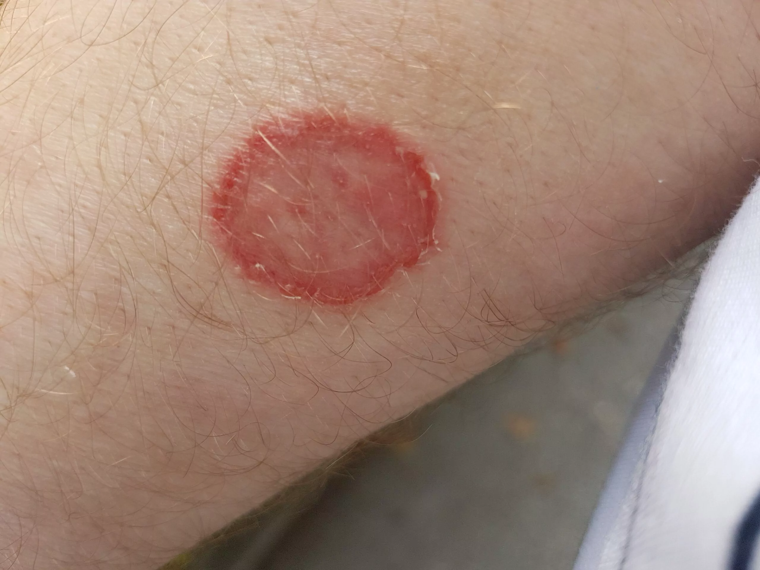 Fungal and Bacterial Infections