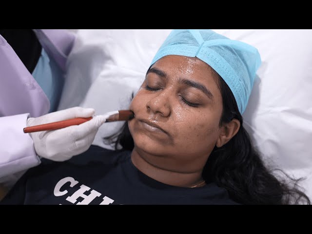 Chemical Peels